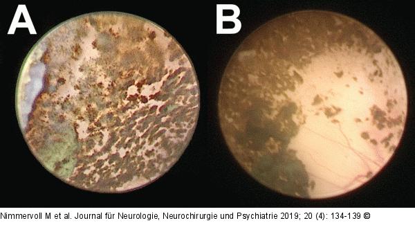 Hämosiderinauflagerungen