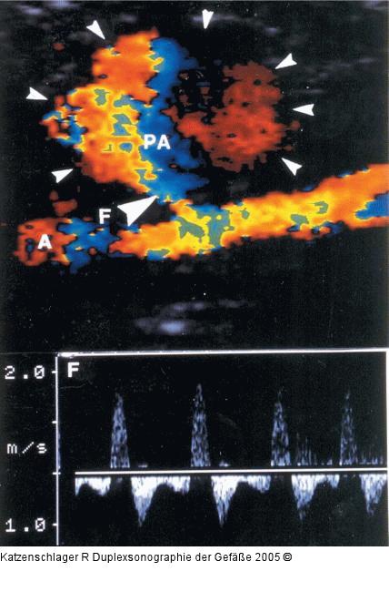 Duplexsonographie - A. femoralis sup. - Pseudaneurysma