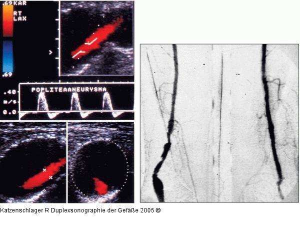 Duplexsonographie - A. poplitea - Aneurysma