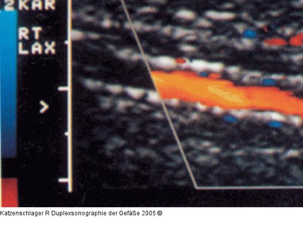 Duplexsonographie - A. tibialis post. - Sklerose