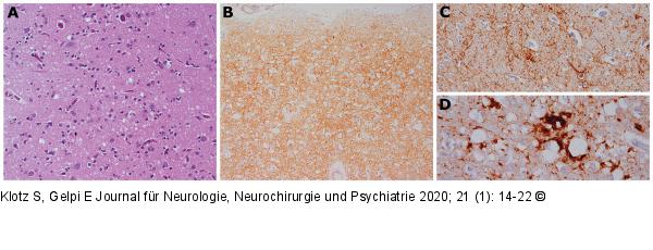 Creutzfeldt-Jakob-Krankheit