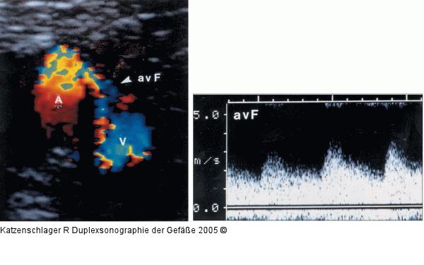 Duplexsonographie - AV-Fistel