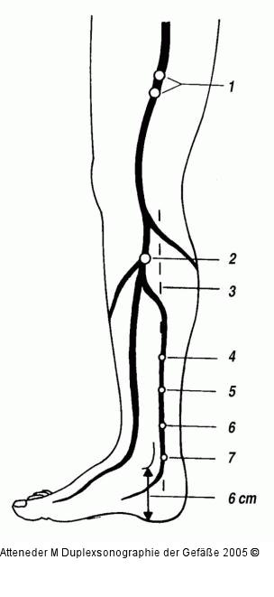 Duplexsonographie - Perforansvenen