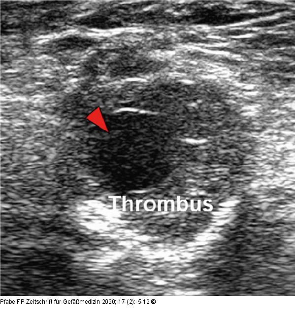 PAA im Gefäßultraschall