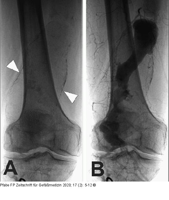 PAA bei Arteriomegalie