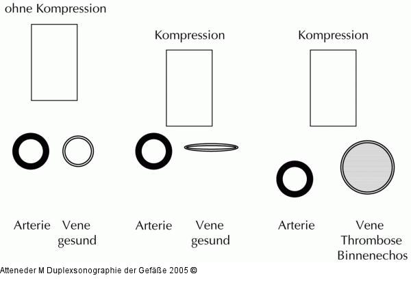 Duplexsonographie - Kompressionssonographie