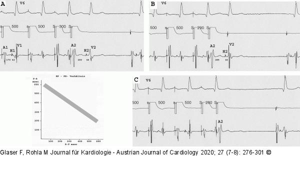 Dekrementale Leitung - AVN