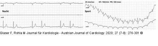 Bradykardie - Wenckebach-Typ AV-Block