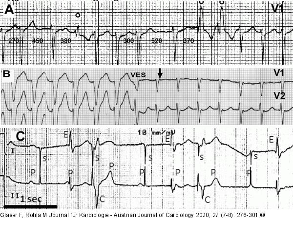 Ashman-Phänomen - VES