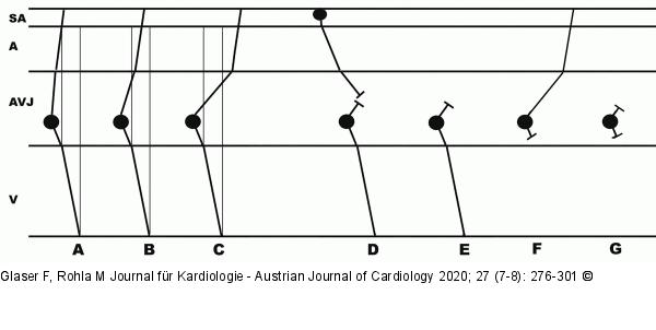 AV-Junctionale Rhythmen