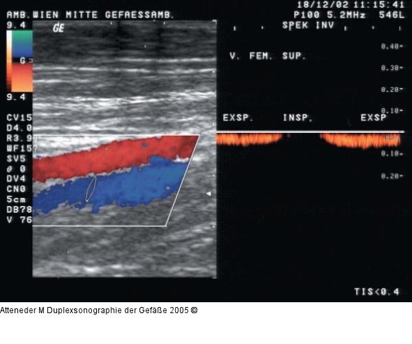 Duplexsonographie - Spontanes Venensignal
