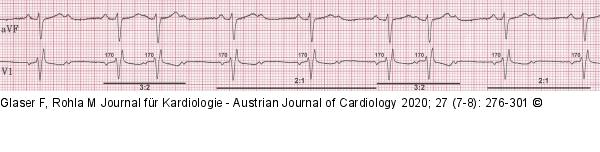 Mobitz II- (Typ 2-) AV-Block 