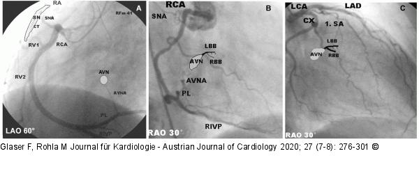 Sinusknoten - AV-Knoten