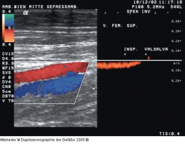Duplexsonographie - V. fem. sup.