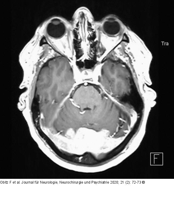 Okzipitale Tumormasse