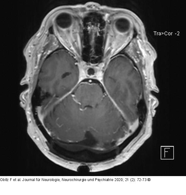Okzipitalen Blutleiter