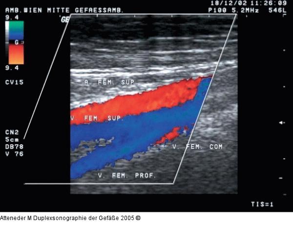 Duplexsonographie - Farbdoppler