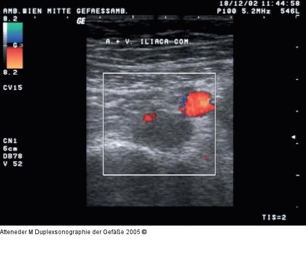 Duplexsonographie - Thrombose