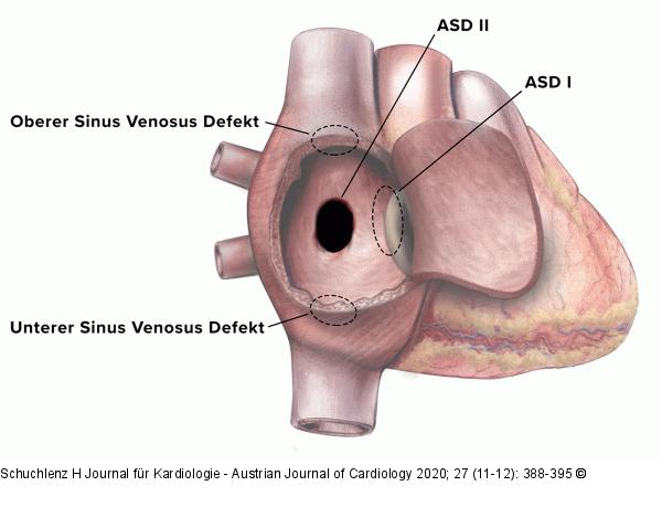 Interatriales Septum