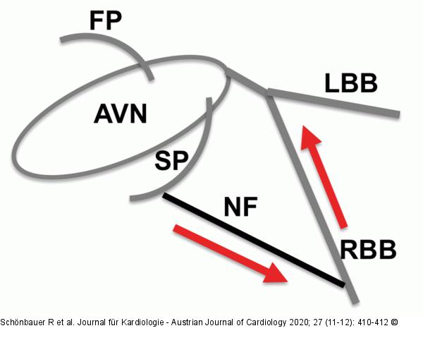 Antidrome nodofaszikuläre Tachykardie
