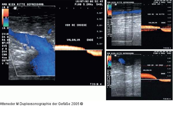 Duplexsonographie - V. saphena