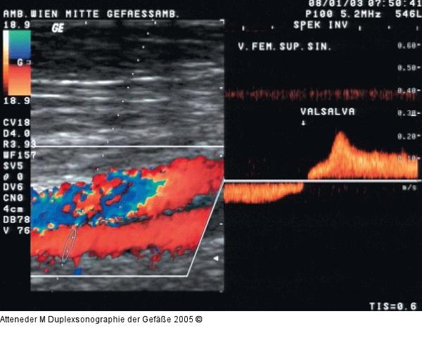 Duplexsonographie - Postthrombotisches Syndrom