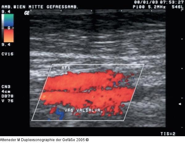 Duplexsonographie - Postthrombotisches Syndrom