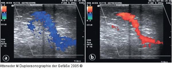 Duplexsonographie - Perforansinsuffizienz