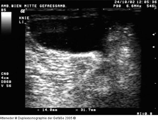Duplexsonographie - Bakerzyste