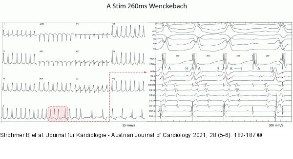 Wenckebach-Verhalten