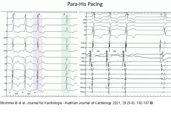 Para-His-Pacing