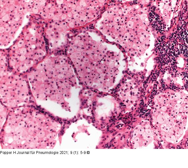 Lipidpneumonie - EVALI