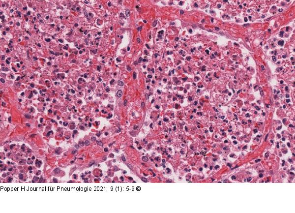 Eosinophilenpneumonie
