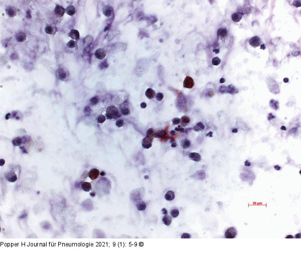 BAL - Lipidpneumonie