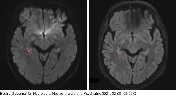 Punktförmige MRT-Läsion