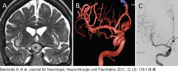 Intrakranielles Aneurysma