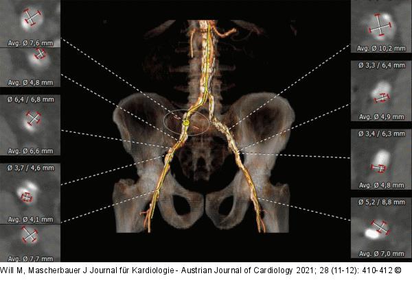 Aorta abdominalis - Beckengefäße