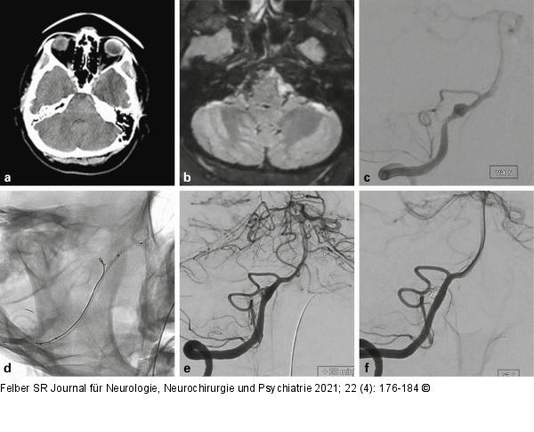 Dissektionsaneurysma