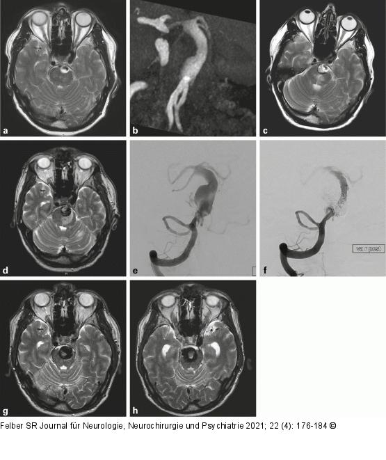 Arteriosklerotisches Aneurysma
