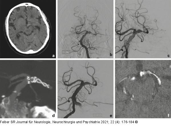 Arteriosklerotisches Aneurysma