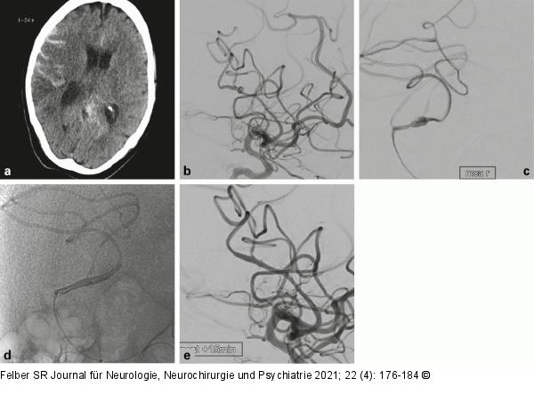 Mykotisches Aneurysma