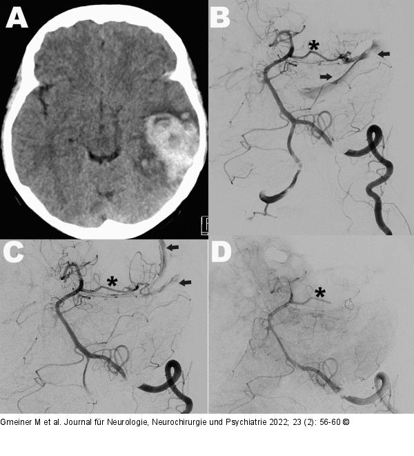 Piale arteriovenöse Fistel