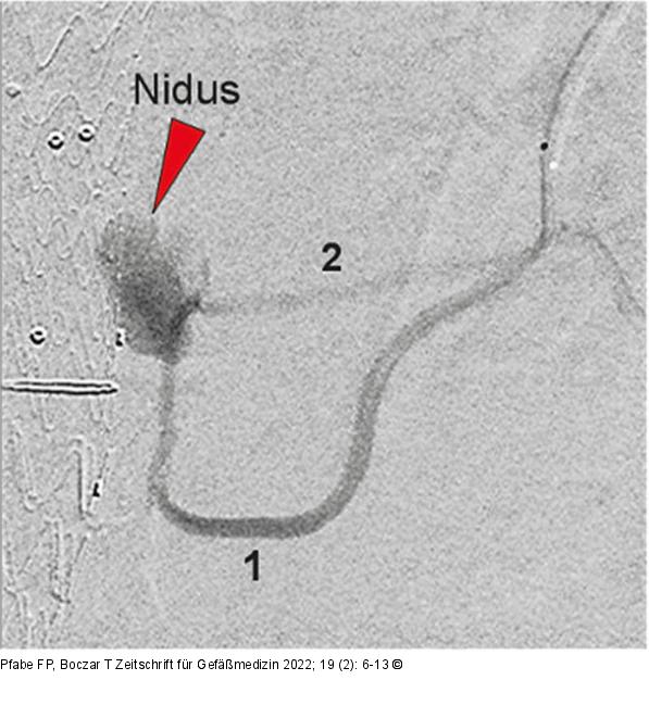 Arteria mesenterica inferior
