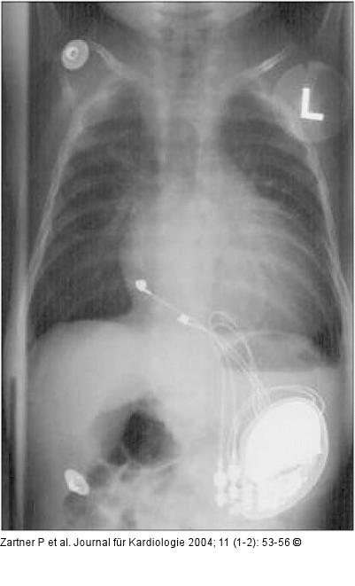 Herzschrittmacher - Kinderkardiologie