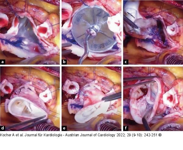  Homograft-Implantation