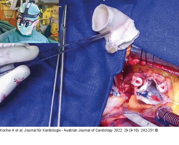 Dezellularisierter Homograft