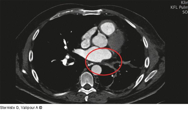 Pulmonalvenenstenose