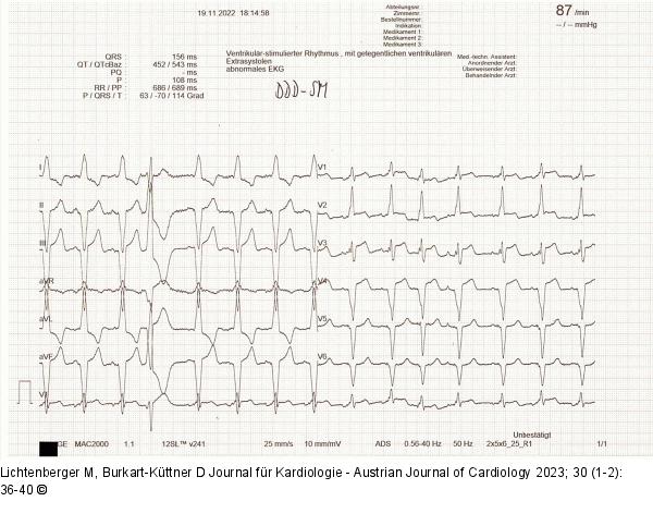 EKG