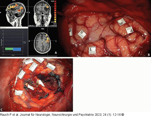 Intraoperative Stimulation
