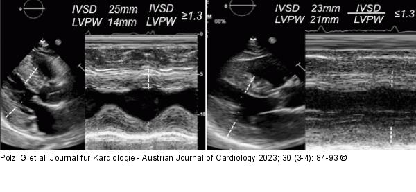 Hypertrophe Kardiomyopathie - Kardiale Amyloidose